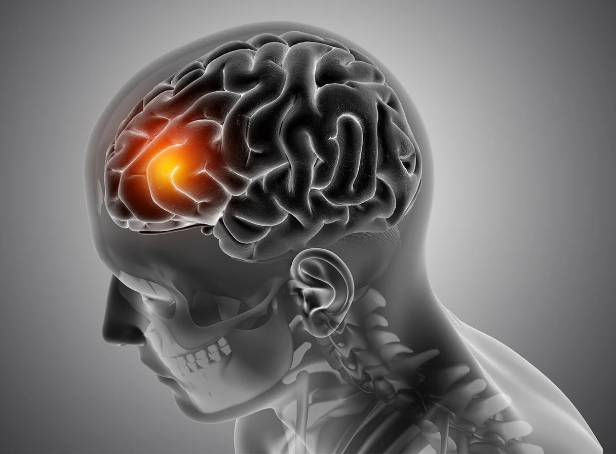 Concussion: Causes, Symptoms, and Recovery